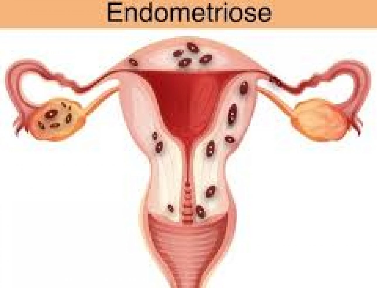 imagem-endometriose-utero